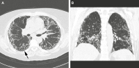 Abbildung 1a-b: Usual Interstitial Pneumonia - UIP