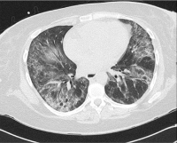 Abbildung 3: Non-specific Interstitial Pneumonia - NSIP