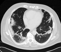 Abbildung 4: Pneumonie