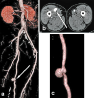 Abbildung 3a-c: CT-Angiographie