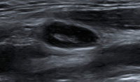 Abbildung 1: Ultraschall-Lymphknoten