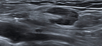 Abbildung 4: Ultraschall-Lymphknoten