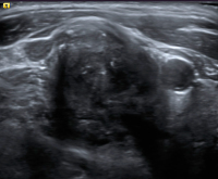 Abbildung 6: Ultraschall-Lymphknoten