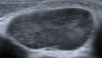 Abbildung 7: Ultraschall-Lymphknoten