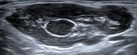 Abbildung 8: Ultraschall-Lymphknoten