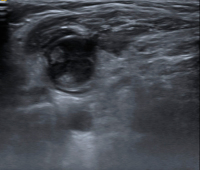 Abbildung 9: Ultraschall-Lymphknoten