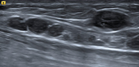 Abbildung 10: Ultraschall-Lymphknoten