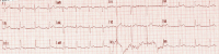 Abbildung 1: Präklinisches EKG