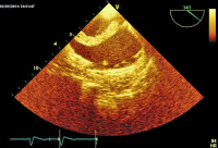 Abbildung 6: Thromboembolus
