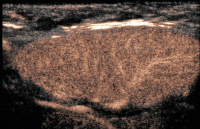 Abbildung 5: Lymphknoten-Ultraschall