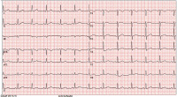 Abbildung 1: EKG