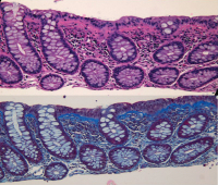 Abbildung 2a-b: Eosinophiles Kollagenband