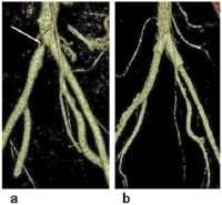 Abbildung 2a-b: Becken-Arterien