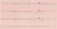 Abbildung 1: EKG