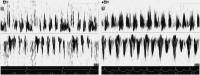 Figure 3: Echokardiographie - Linksatriale Thromben