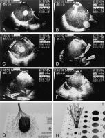 Figure 1A-H: Thrombus - Filter