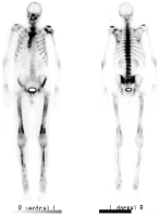 Abbildung 1: Hypertrophe pulmonale Osteoarthropathie
