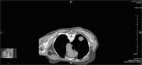 Abbildung 2: Hypertrophe pulmonale Osteoarthropathie