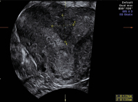 Abbildung 1: Uterus subseptus