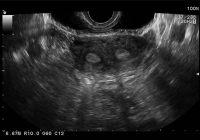 Abbildung 3: Uterus subseptus