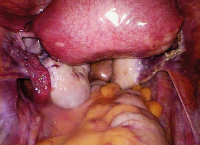 Abbildung 4: Uterus subseptus