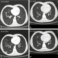 Abbildung 1A-D: Pulmonalembolie