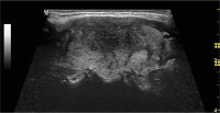 Abbildung 3: Subakute Thyreoiditis