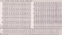 Abbildung 1: EKG