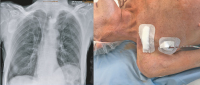 Abbildung 3: Herzchirurgie - Post-OP
