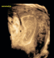 Abbildung 3: Ultraschall-Serometra