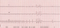 Abbildung 2: EKG - Monitoring