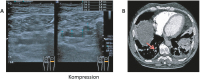 Abbildung 1a-b: Distale Thrombose