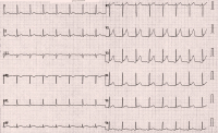 Abbildung 4: EKG