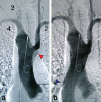 Abbildung 4: Angiographie - Aorta