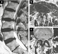 Abbildung 1a-c: Vertebrostenose