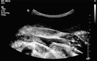 Abbildung 2: Thrombus - Vena subclavia