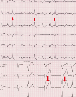 Abbildung 1: Ventricular premature beats