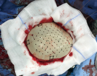 Abbildung 5: PEEK-Implantat