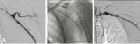Abbildung 7A-C: Perkutane transluminale Angioplastie