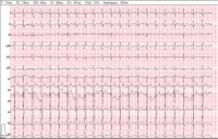 Abbildung 1: EKG