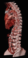 Produkt: Stentgraft<br>
Vertrieb: Jotec GmbH