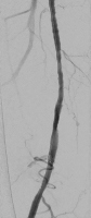 Abbildung 3: A. femoralis superficialis
