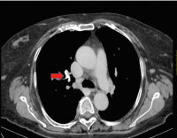 Abbildung 7: Thorax-CT