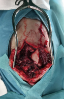 Abbildung 3: Intraoperative Fotografie