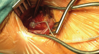 Abbildung 2: Sondennaht