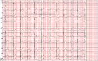 Abbildung 1: EKG
