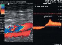 Abbildung 16: Duplexsonographie - Postthrombotisches Syndrom