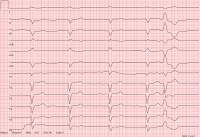 Abbildung 1: EKG