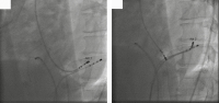 Abbildung 3: Ablation
