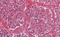 Abbildung 6: Eosinophilenpneumonie